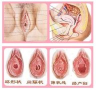 做处女膜修复要多少钱