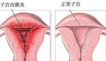 女性得子宫内膜炎是怎么回事