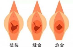 处女膜修补手术疼吗