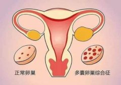 患有双侧多囊卵巢严重吗