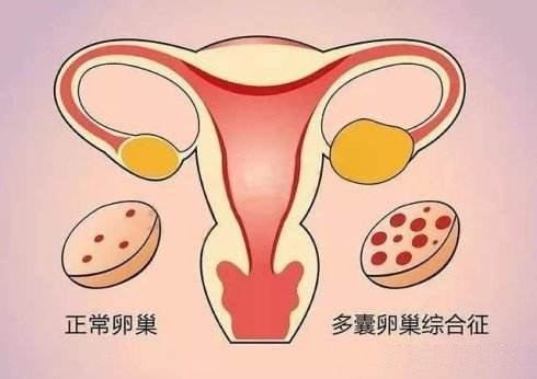 双侧多囊卵巢严重吗
