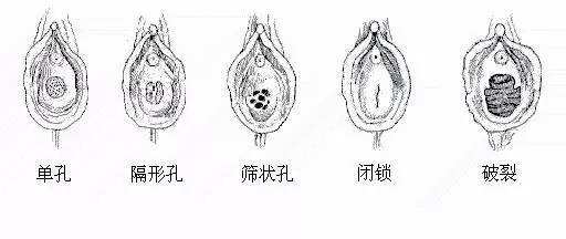 处女膜多久可以修复